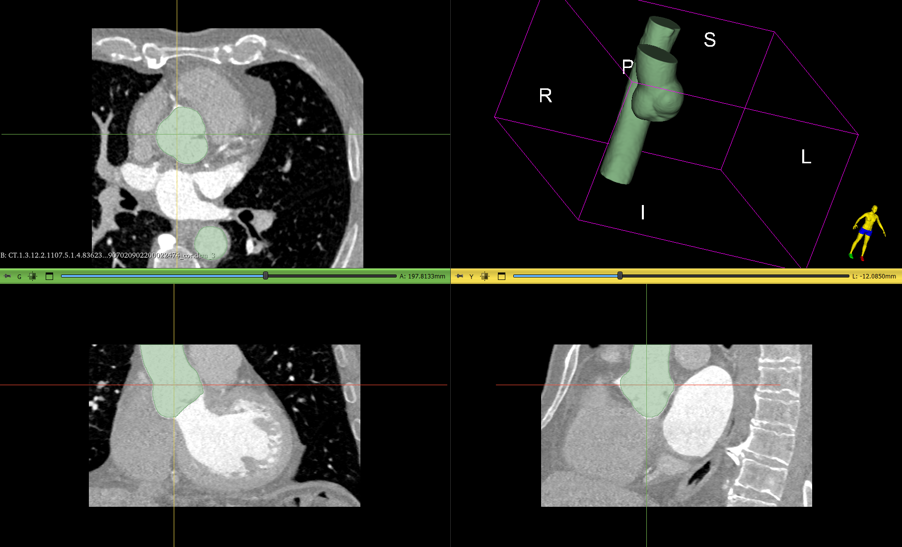 Сегментация: Аорта