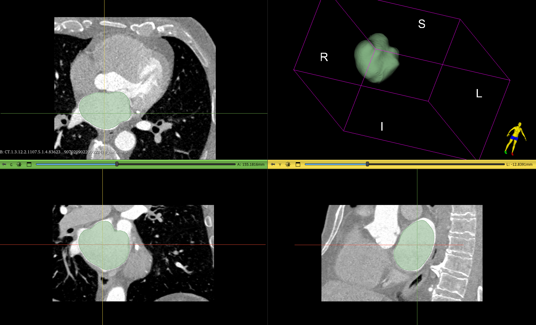 Сегментация: Левое предсердие