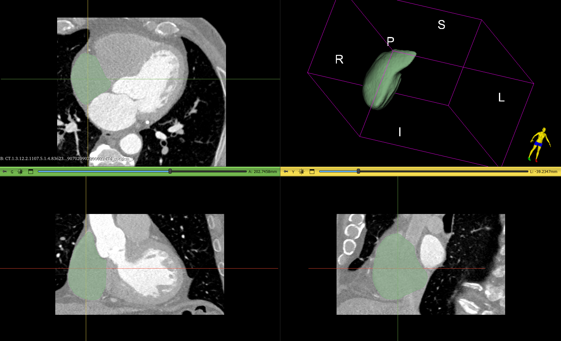 Сегментация: Правое предсердие