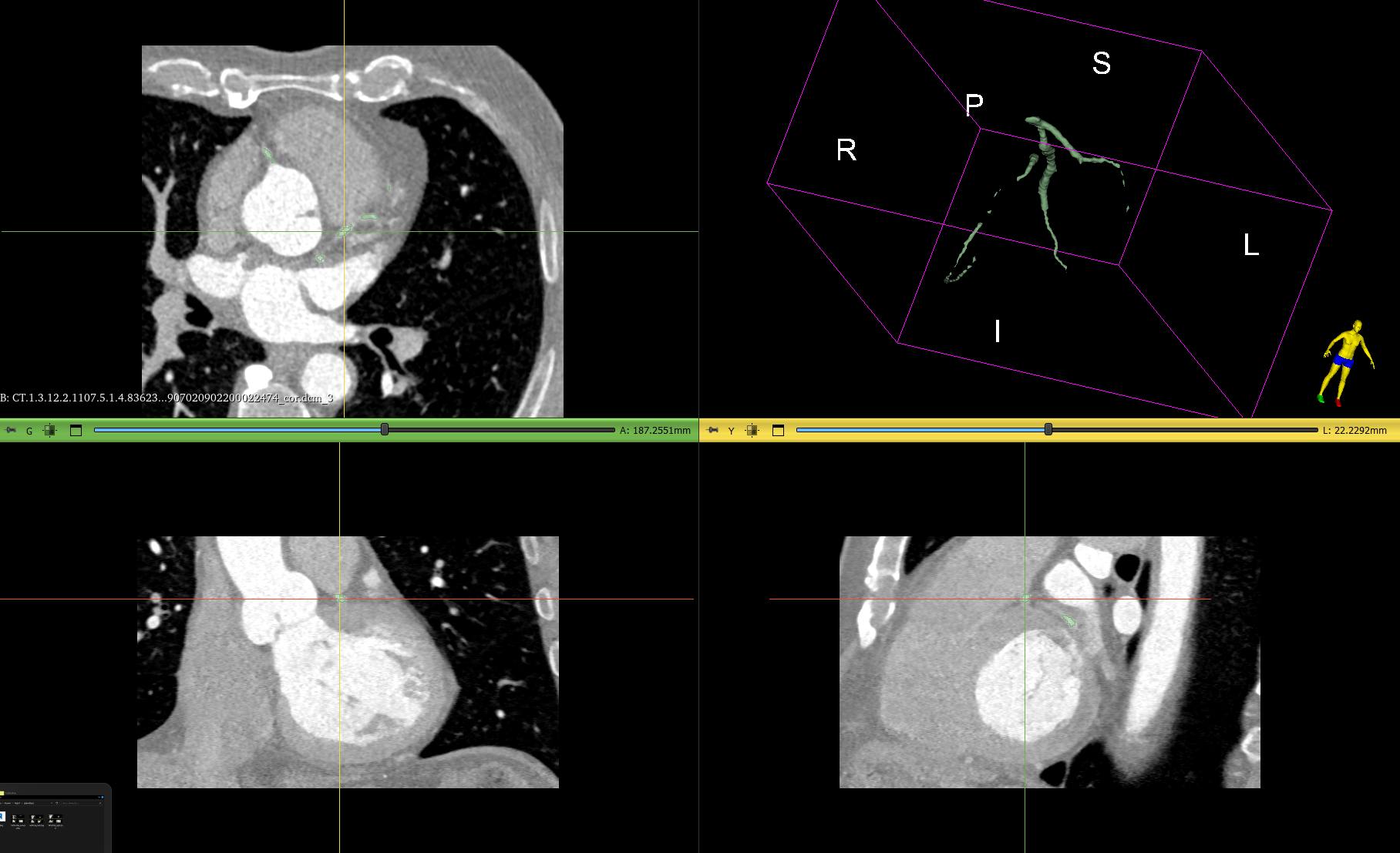 Сегментация: Коронарные артерии