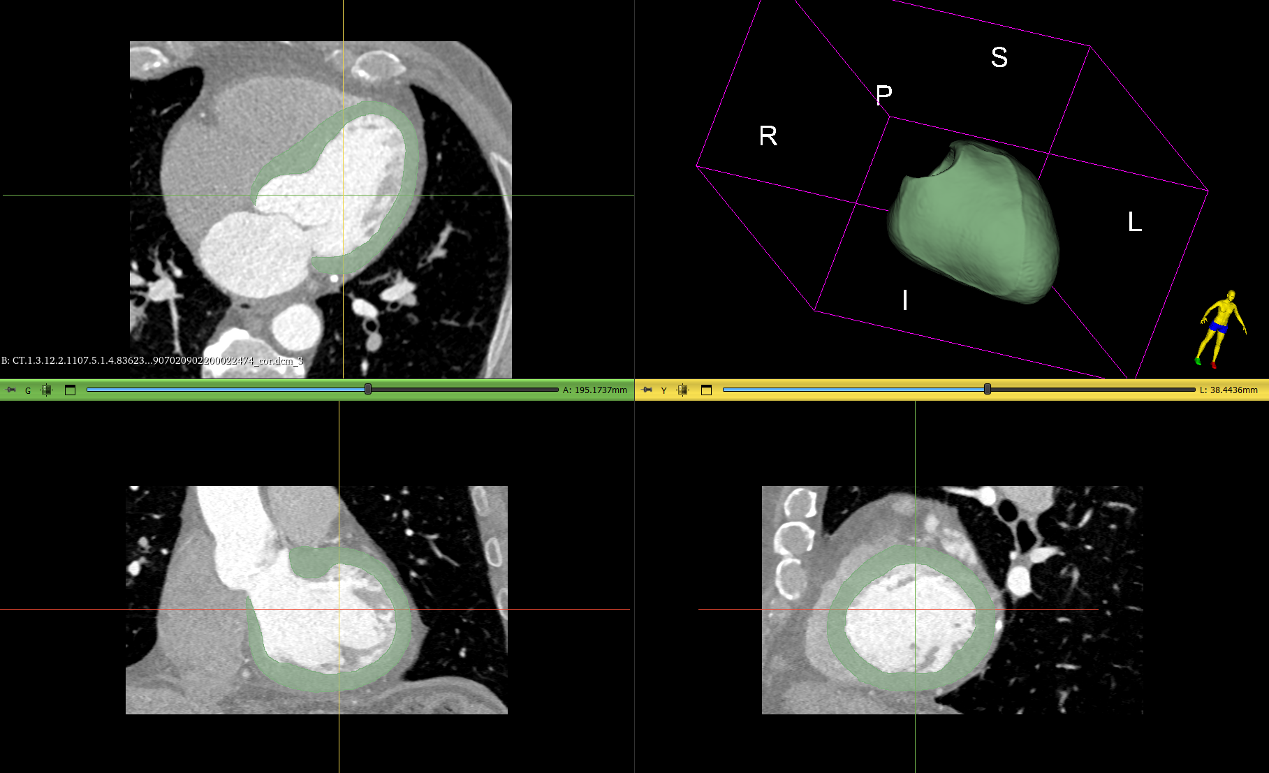 Сегментация: Миокард