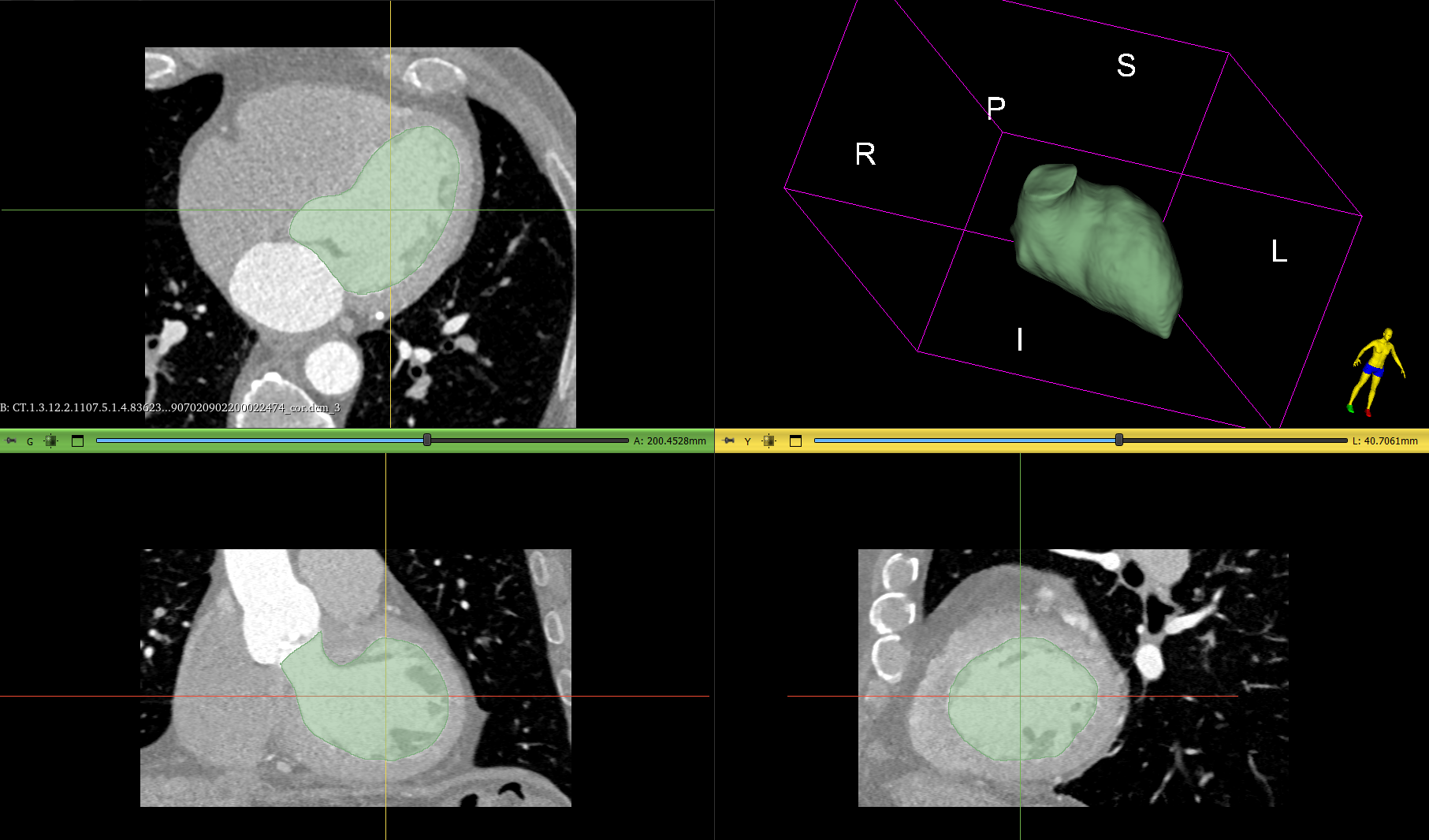 Сегментация: Левый желудочек