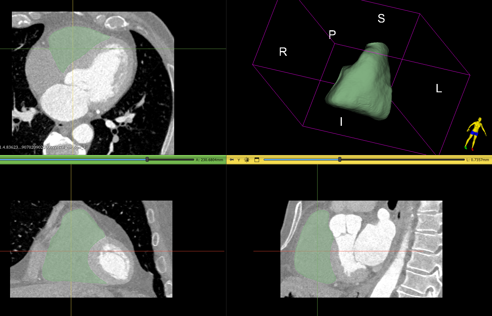 Сегментация: Правый желудочек